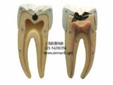 磨牙蛀牙解剖放大模型
